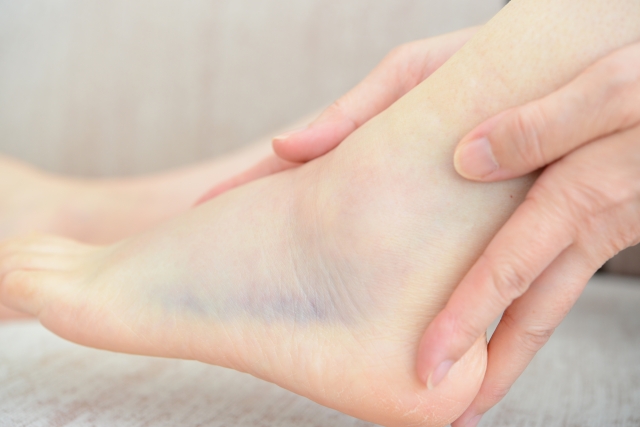 足首を捻挫して晴れたイメージ画像