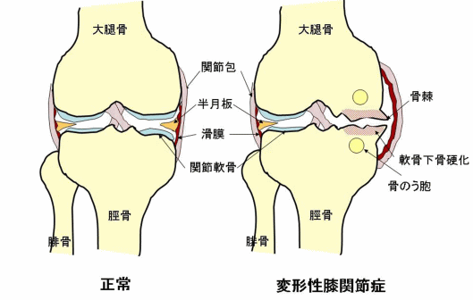 正常な膝関節と変形膝関節の図解説明図