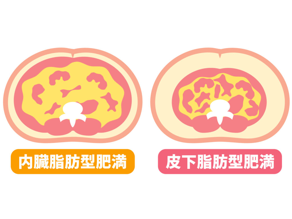 内臓脂肪型肥満と皮下脂肪型肥満の比較イラスト